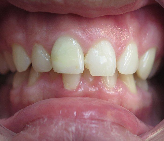 Composite fillings — before