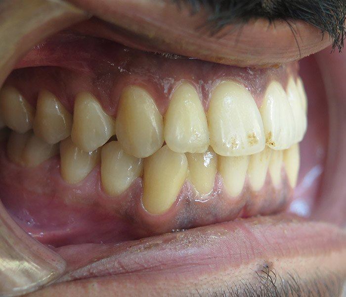 Smile transformation — before