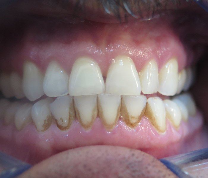 Smile transformation — before