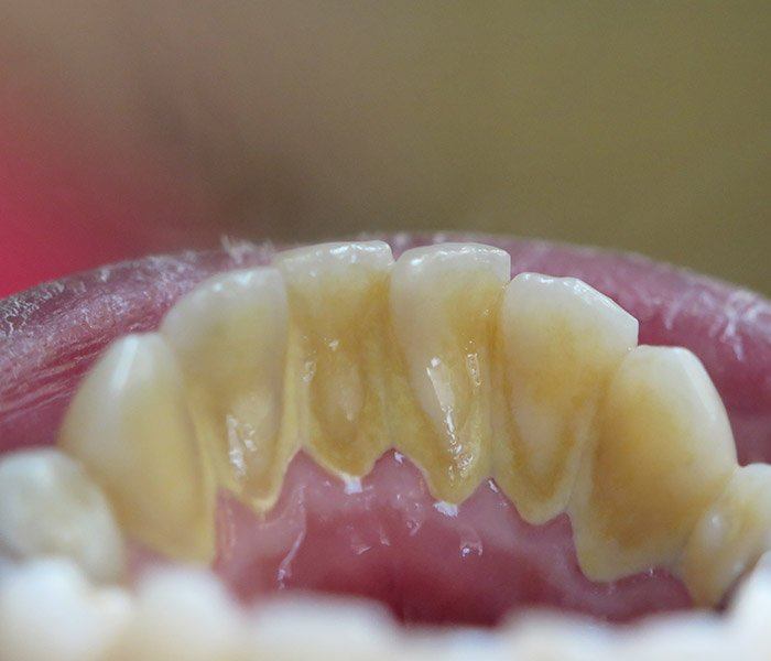Smile transformation — before