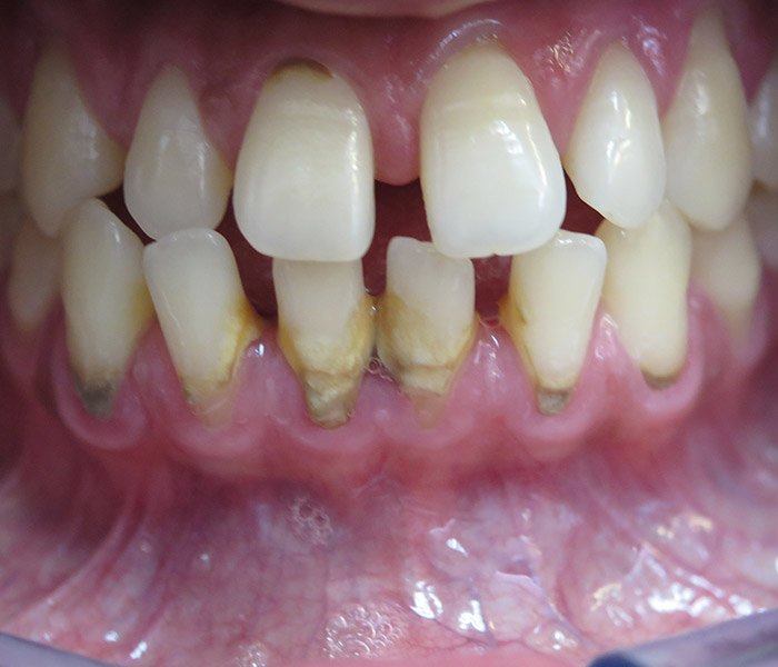 Teeth cleaning — before