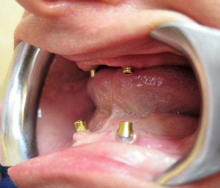 Smile transformation — before