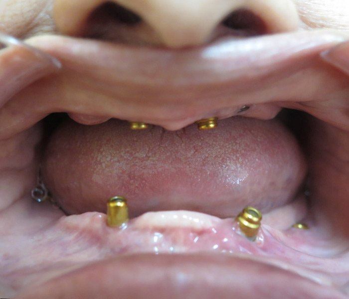 All-on-4 dental implants — before
