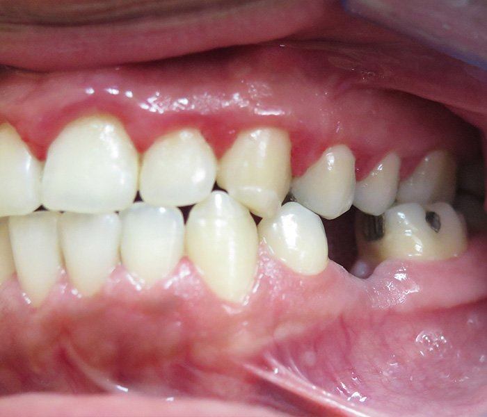 Smile transformation — before
