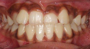 Orthodontics — before