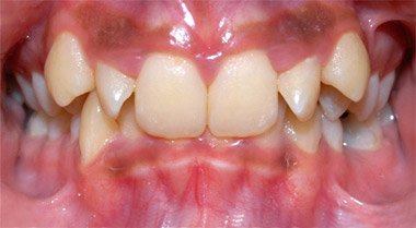 Orthodontics — before