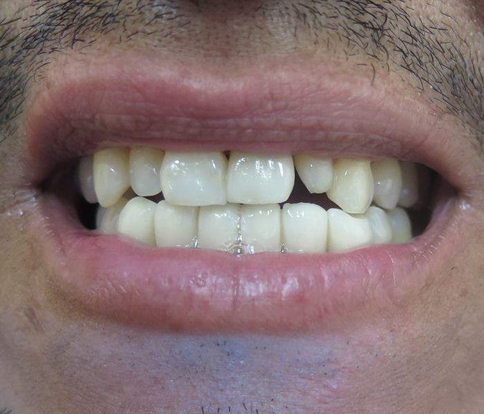 Veneers — before