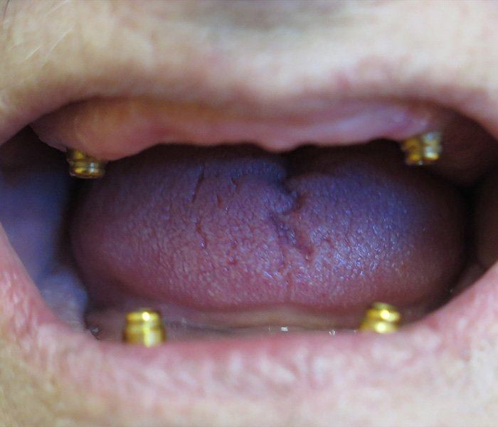 All-on-4 dental implants — before
