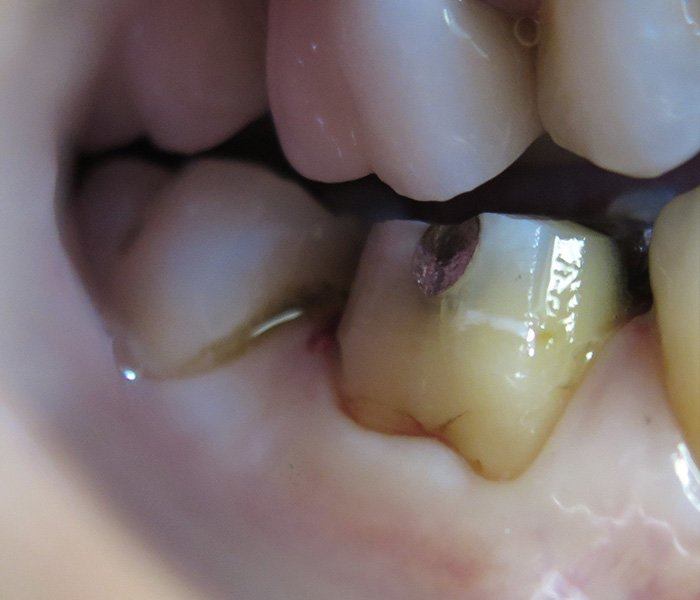 Dental crowns — before