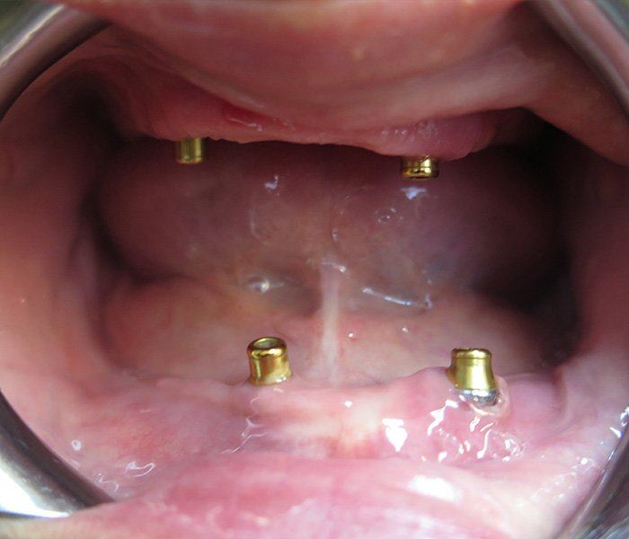 All-on-4 dental implants — before