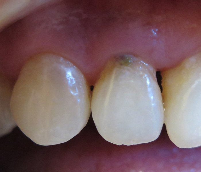 Composite fillings — before