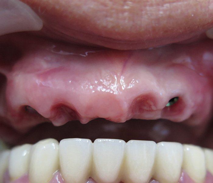 Smile transformation — before