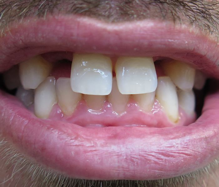 Smile transformation — before