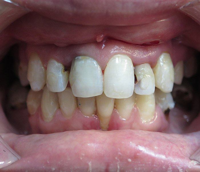 Smile transformation — before