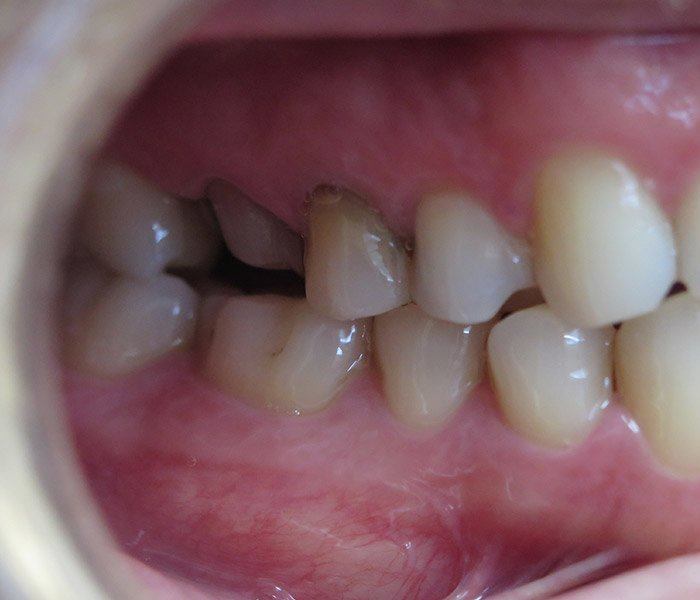 Dental crowns — before