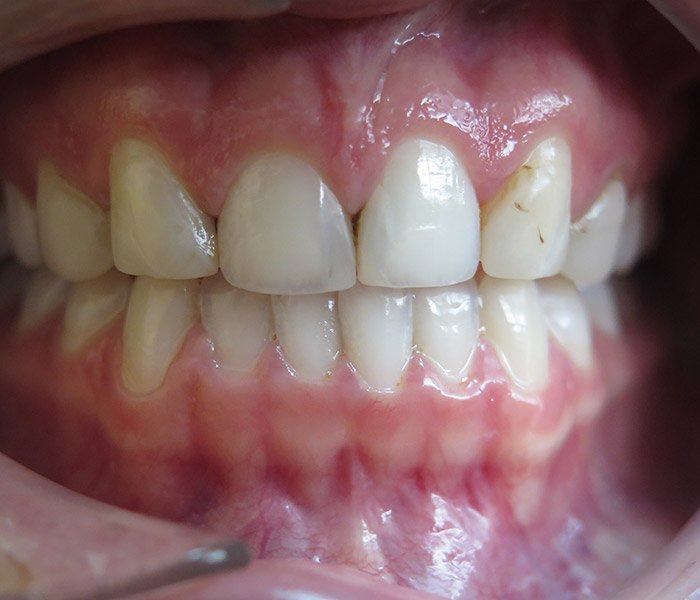 Smile transformation — before