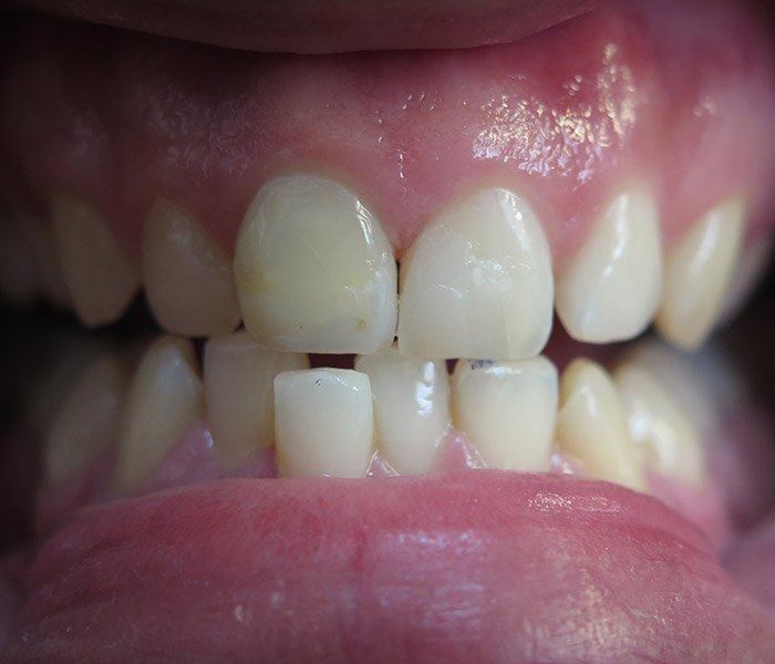 Composite fillings — after