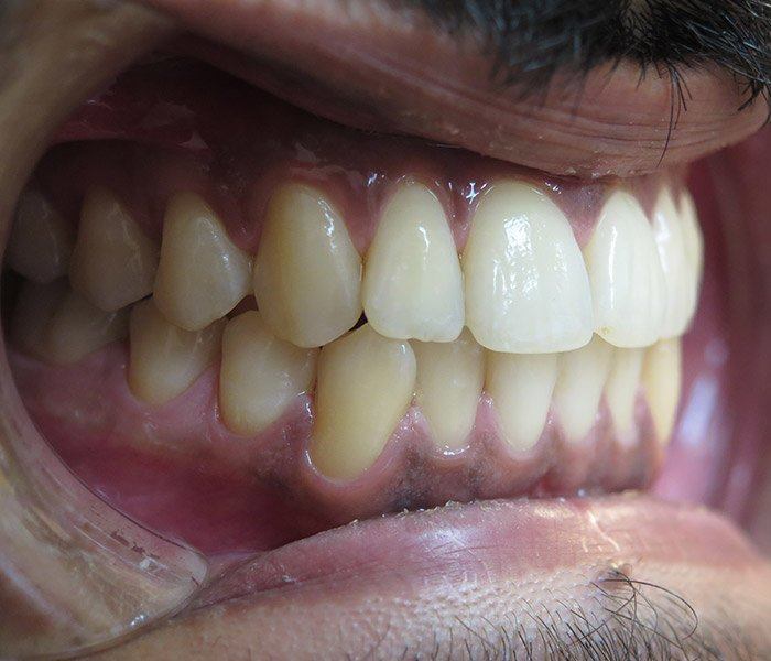 Smile transformation — after