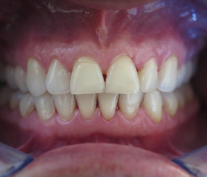 Smile transformation — after