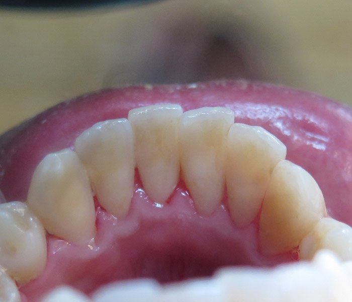 Smile transformation — after