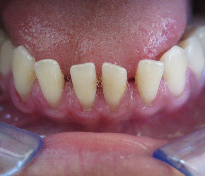 Teeth cleaning — after