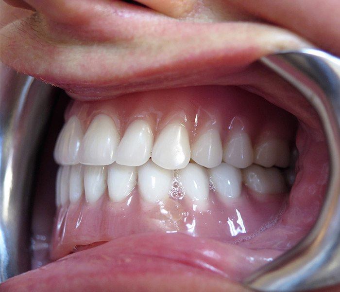 Smile transformation — after