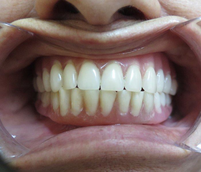 All-on-4 dental implants — after