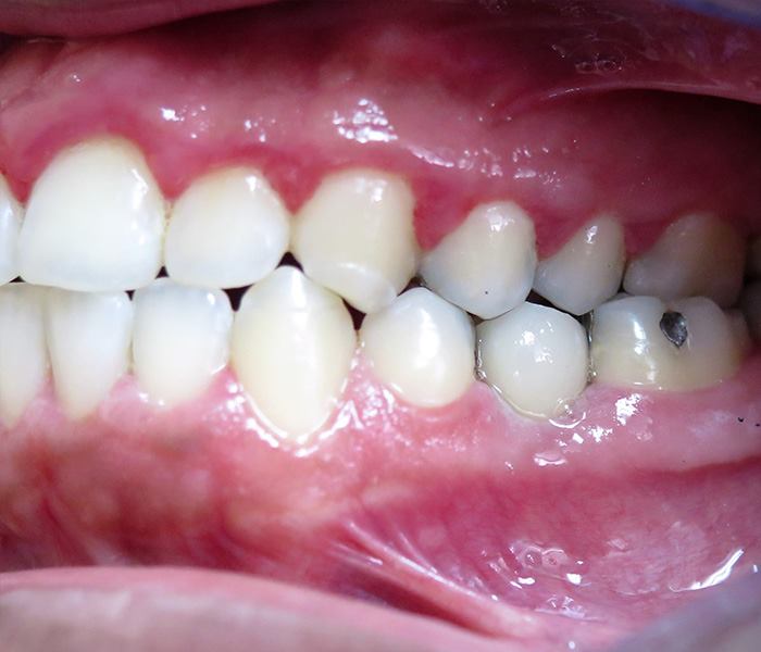 Smile transformation — after