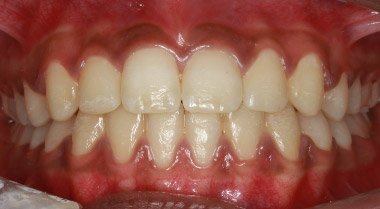 Orthodontics — after