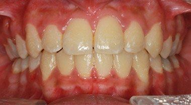 Orthodontics — after