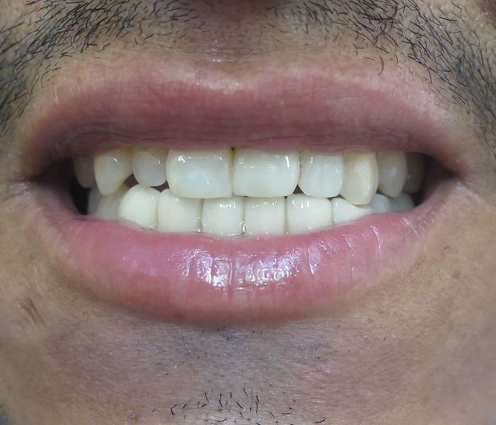 Veneers — after