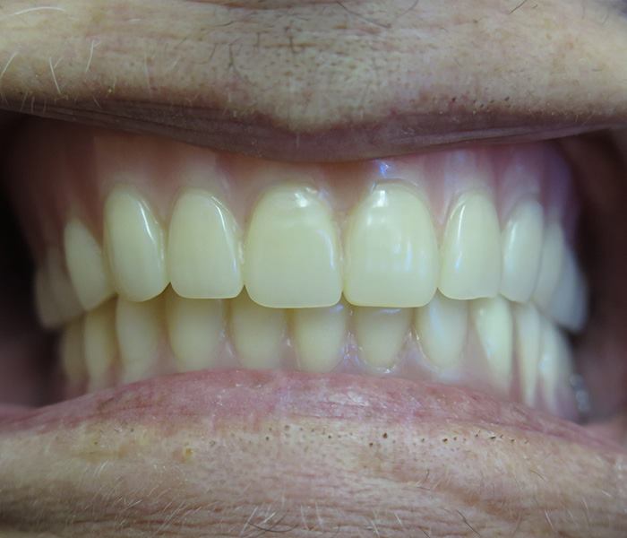 All-on-4 dental implants — after