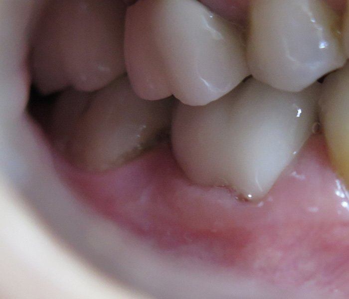 Dental crowns — after