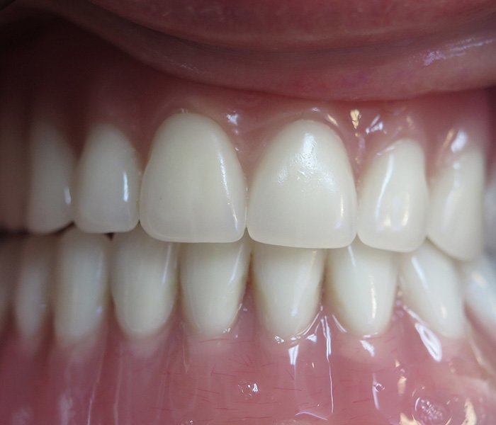 All-on-4 dental implants — after