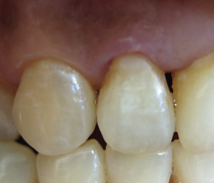 Composite fillings — after