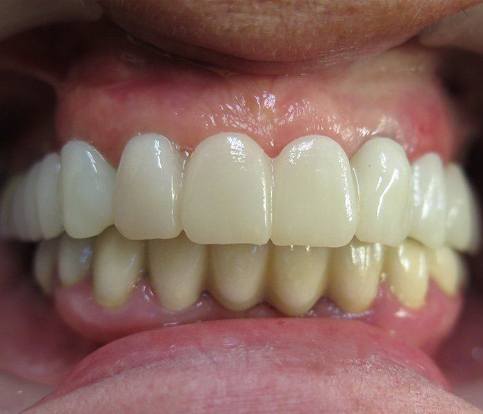 Smile transformation — after