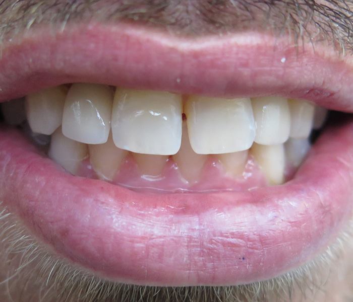 Smile transformation — after