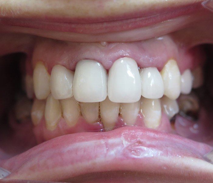 Smile transformation — after
