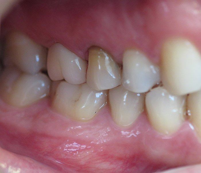 Dental crowns — after