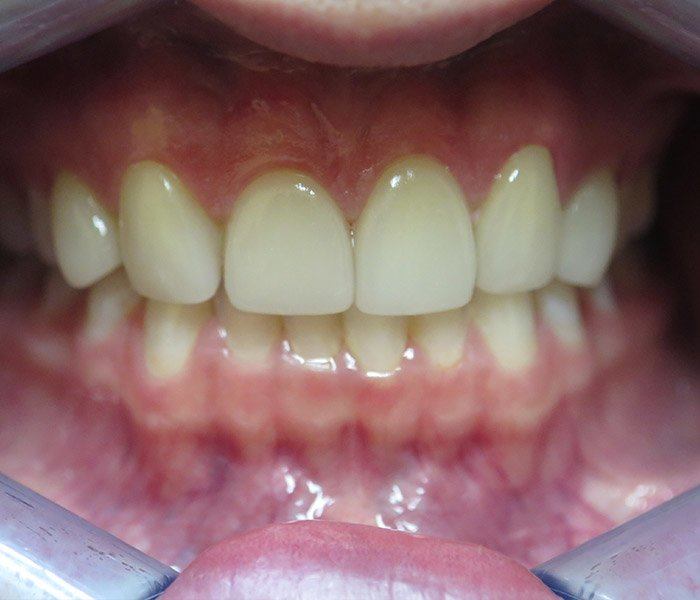 Smile transformation — after