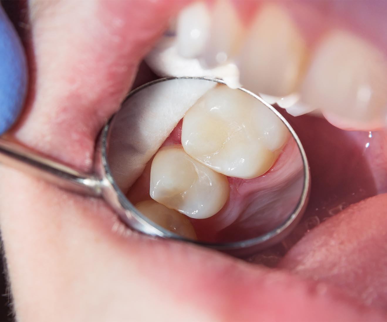 Composite tooth-colored fillings