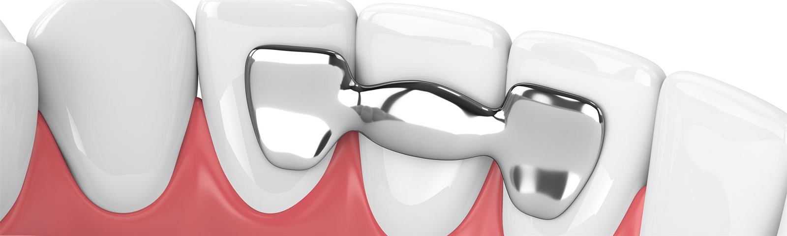 Dental Bridges