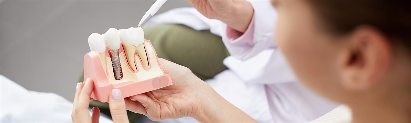 Dental implant model