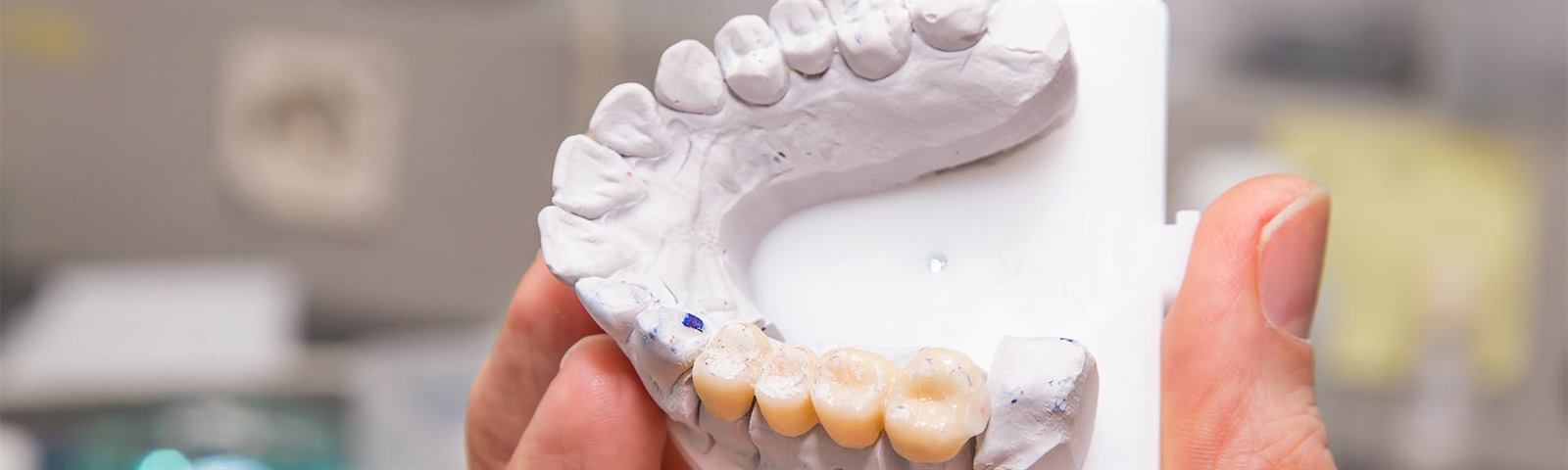 Porcelain fixed bridge