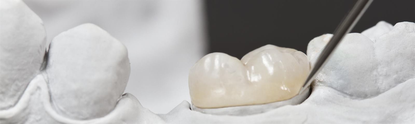 Porcelain inlays and onlays