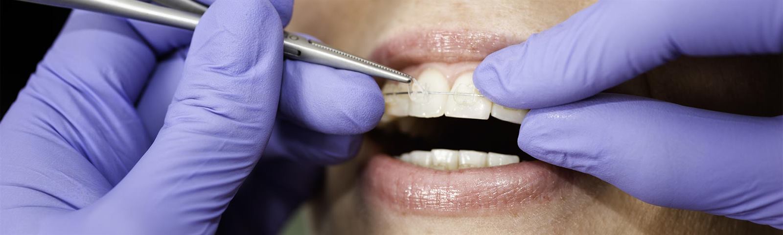 Porcelain ceramic braces