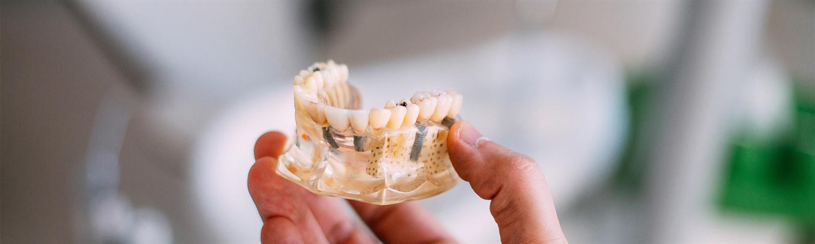 Multiple Teeth Implants