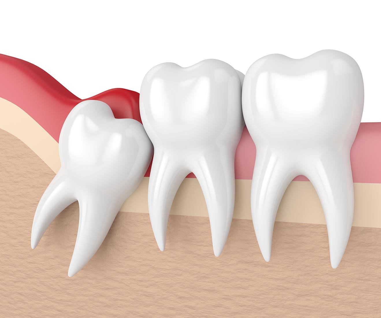 Wisdom Teeth Removal