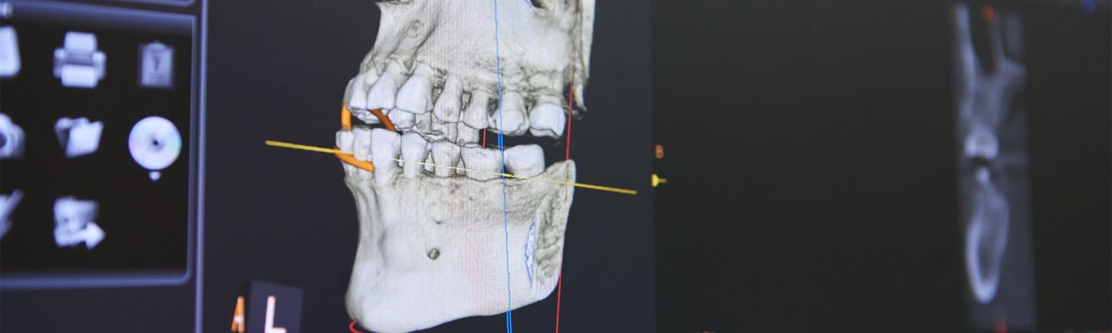 A digital dental scan on screen